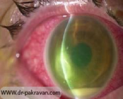 عفونت قرنیه بعد از لیزیک می‌تواند باعث از دست رفتن بخش زیادی از بینایی شود.